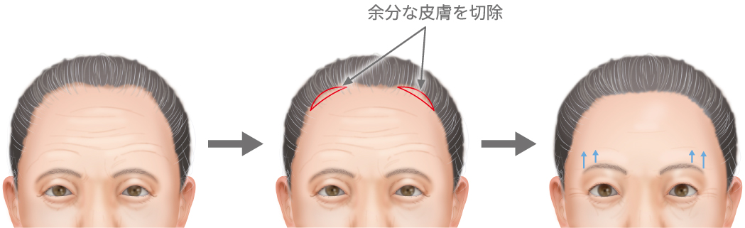 外側ブローリフト