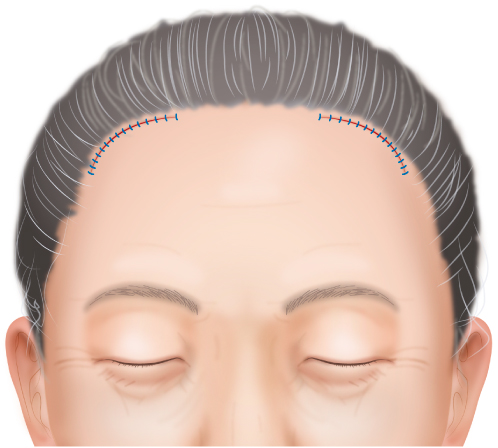 切開口を縫合する。