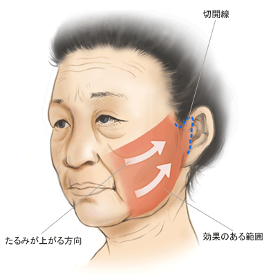 ミニリフト