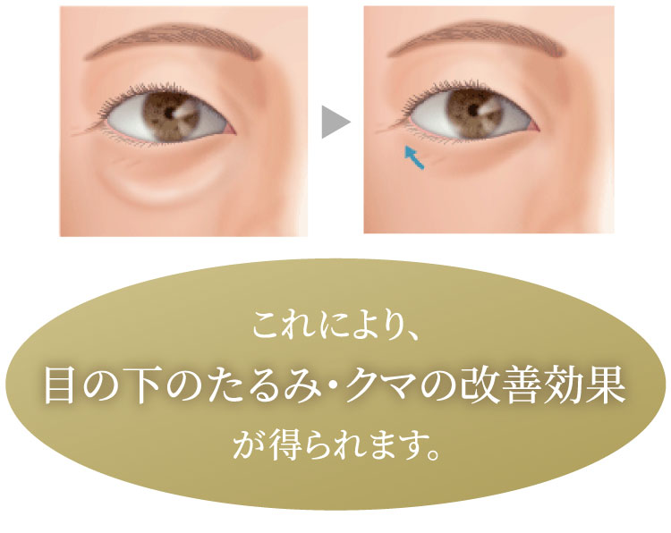これにより、目の下のたるみ・クマの改善効果が得られます。