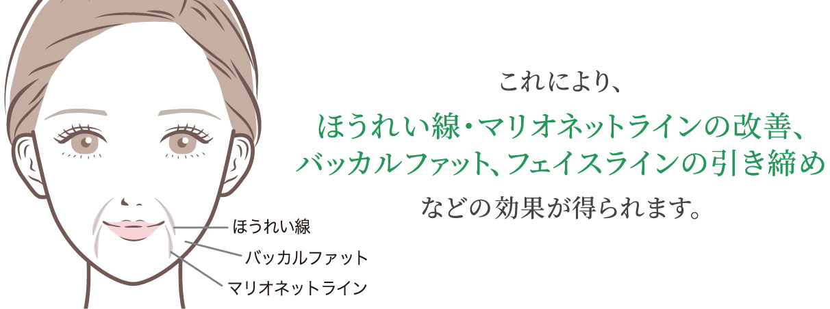 これにより、ほうれい線・マリオネットラインの改善、バッカルファット、フェイスラインの引き締めなどの効果が得られます。