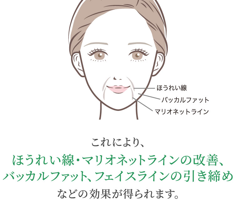 これにより、ほうれい線・マリオネットラインの改善、バッカルファット、フェイスラインの引き締めなどの効果が得られます。