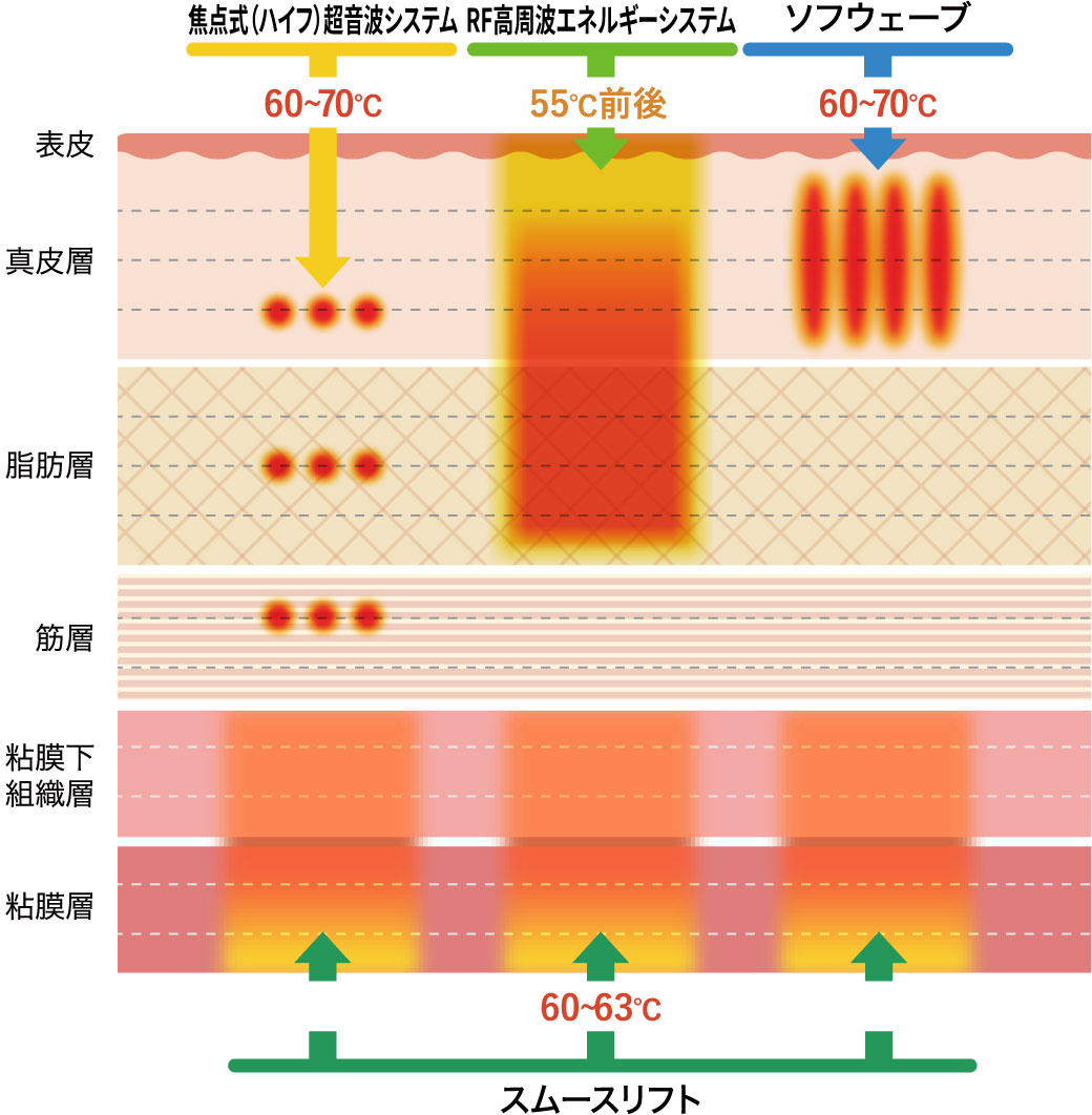 焦点式（ハイフ）超音波システム、RF高周波エネルギーシステム、ソフウェーブ、スムースリフトの照射エリア、効果のあるお肌の層の比較