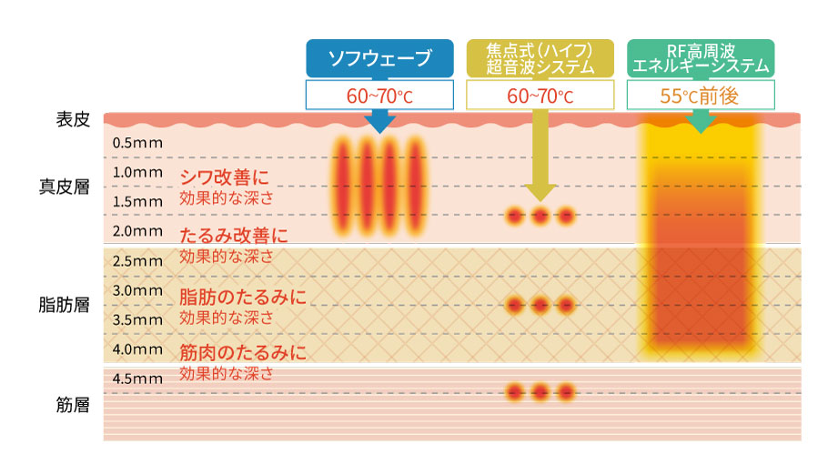 照射エリア、効果のあるお肌の層の比較表