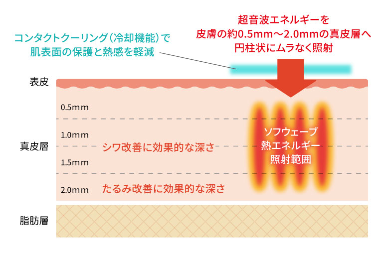 コンタクトクーリング（冷却機能）で
				肌表面の保護と熱感を軽減/超音波エネルギーを皮膚の約0.5mm～2.0mmの真皮層へ円柱状にムラなく照射