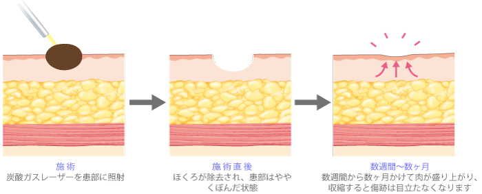 【施術】炭酸ガスレーザーを患部に照射 【施術直後】ほくろが除去され、患部はややくぼんだ状態 【数週間~数ヶ月】数週間から数ヶ月かけて肉が盛り上がり、収縮すると傷跡は目立たなくなります