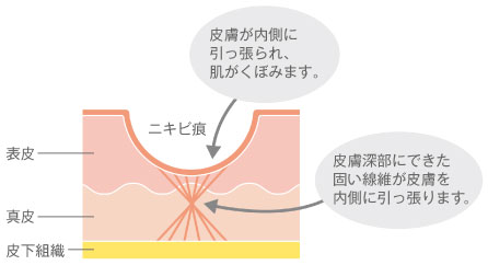 ニキビ跡による肌のくぼみの原因
