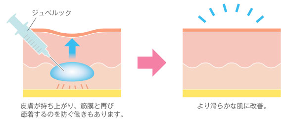 サブシジョン＋ジュベルック治療
