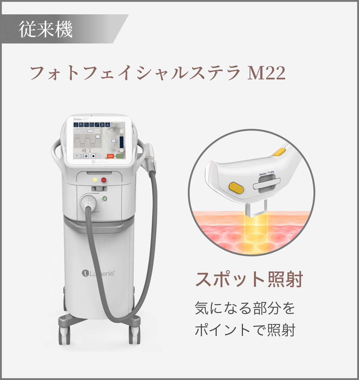 【従来機】フォトフェイシャルステラ M22/(スポット照射)気になる部分をポイントで照射