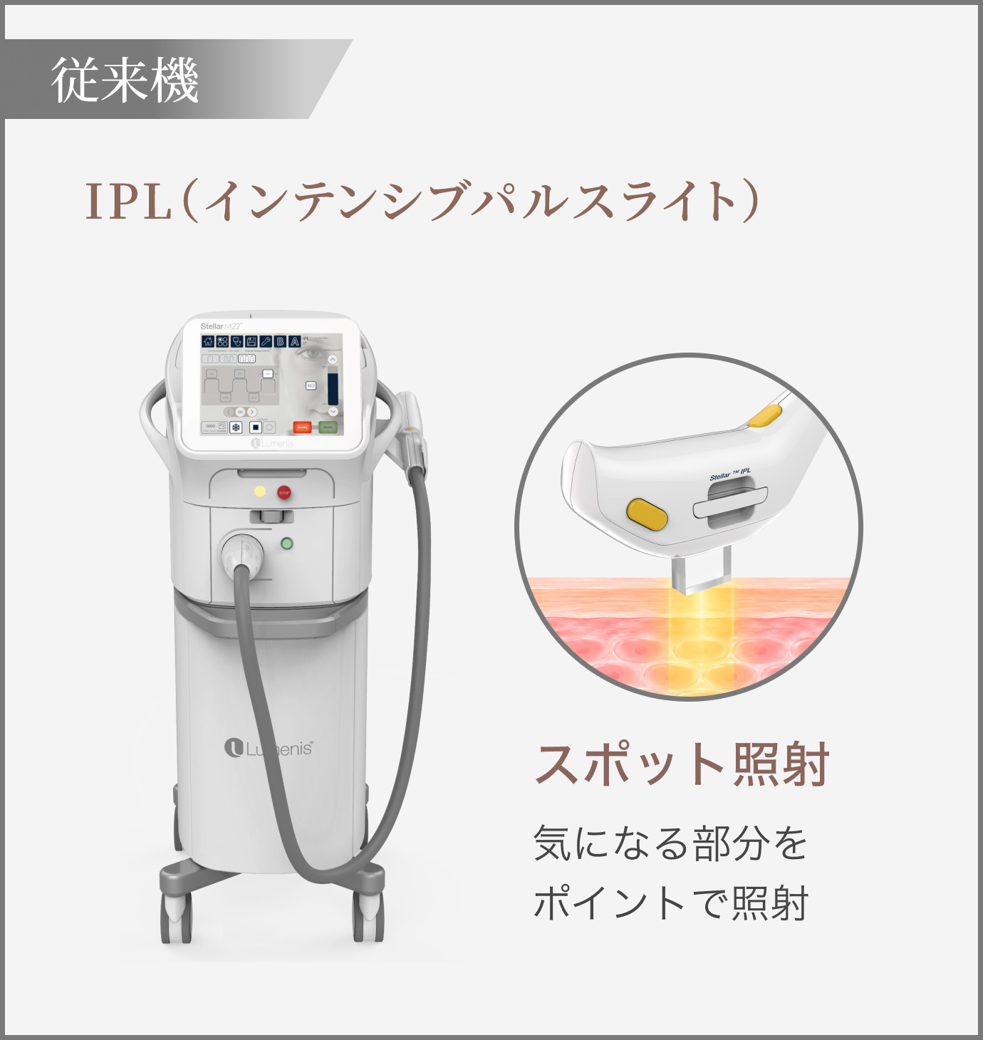 【従来機】IPL（インテンシブパルスライト）／（スポット照射）気になる部分をポイントで照射