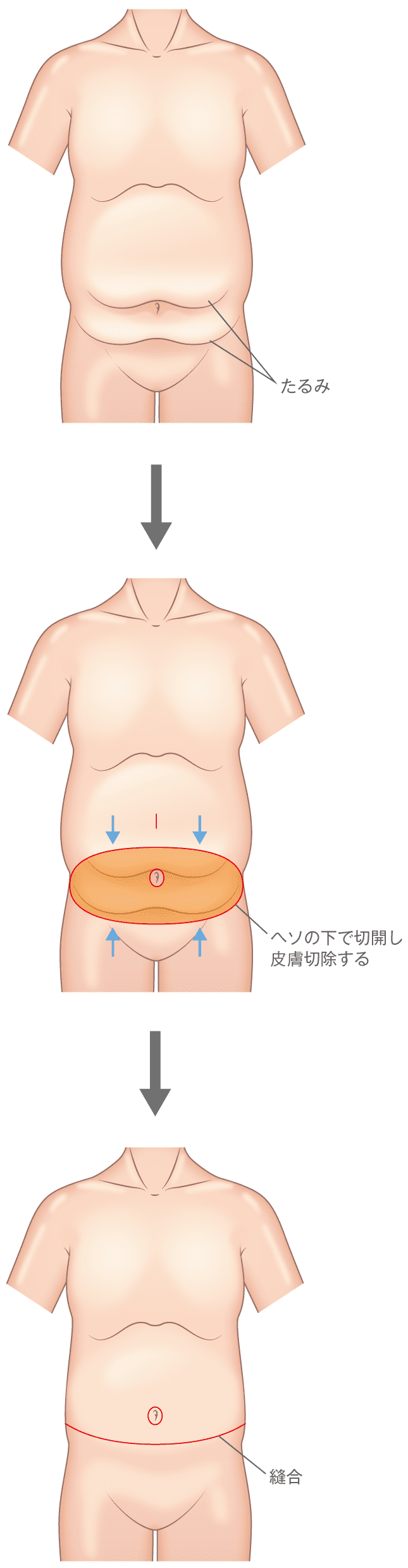 お腹のたるみ タルミ 妊娠線を消す腹リダクション 美容整形の高須クリニック