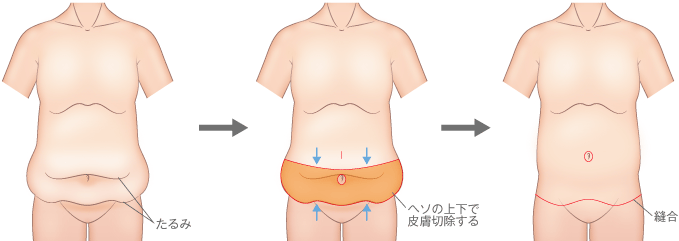 お腹のたるみ タルミ 妊娠線を消す腹リダクション 美容外科 高須クリニック