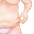 腹リダクション（お腹のたるみ取り）
