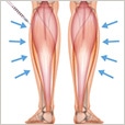 ボツリヌストキシン注射（ふくらはぎ・足やせ・美脚）