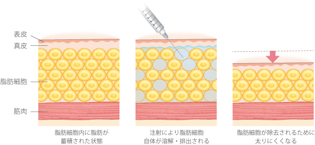 脂肪細胞内に脂肪が蓄積された状態→メソセラピーで、脂肪細胞自体が溶解されるため、脂肪を蓄積できる場所そのものが消失