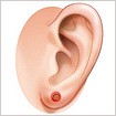 その他の耳の手術