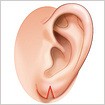 その他の耳の手術