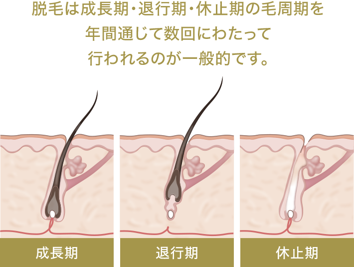 脱毛は成長期・退行期・休止期の毛周期を年間通じて数回にわたって行われるのが一般的です。