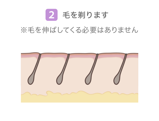 (2)毛を剃ります ※毛を伸ばしてくる必要はありません