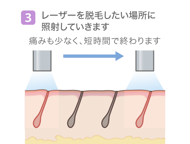 (3)レーザーを脱毛したい場所に照射していきます 痛みも少なく、短時間で終わります