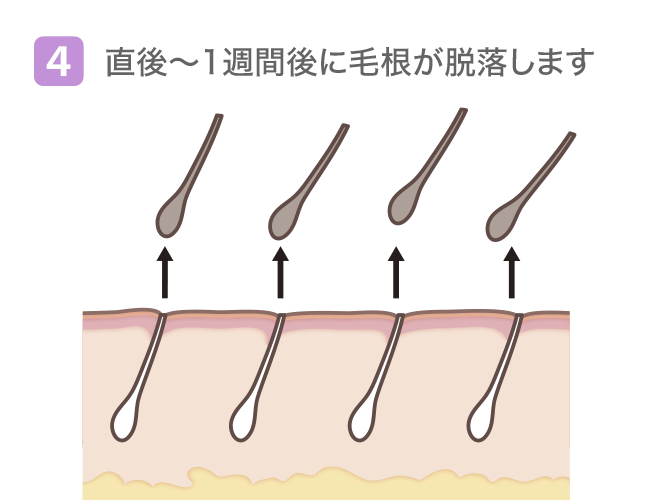 (4)直後〜1週間後に毛根が脱落します