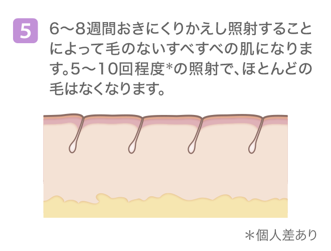 (5)6〜8週間おきにくりかえし照射することによって毛のないすべすべの肌になります。5〜10回程度＊の照射で、ほとんどの毛はなくなります。＊個人差あり