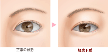 眼瞼下垂の重症度分類
