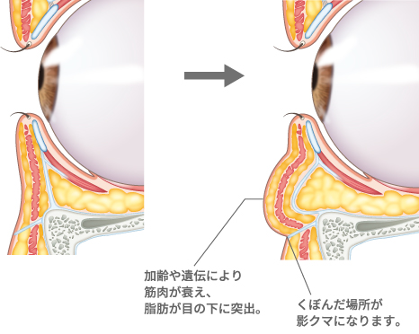 くぼんだ場所が陰クマになります。
