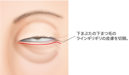 表ハムラ法
