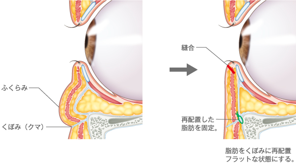 表ハムラ法