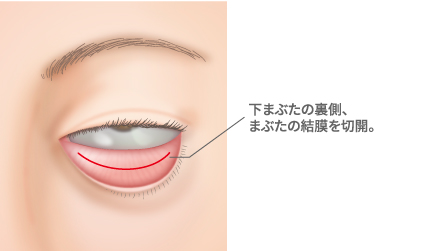 裏ハムラ法