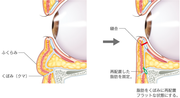 裏ハムラ法
