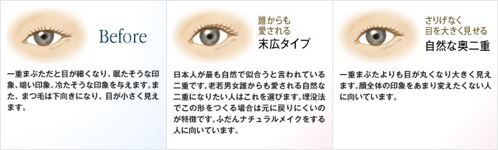 Before：一重まぶただと目が細くなり、眠たそうな印象、暗い印象、冷たそうな印象を与えます。また、まつ毛は下向きになり、目が小さく見えます。／末広タイプ：日本人が最も自然で似合うと言われている二重です。老若男女誰からも愛される自然な二重になりたい人はこれを選びます。埋没法でこの形をつくる場合は元に戻りにくいのが特徴です。ふだんナチュラルメイクをする人に向いています。／自然な奥二重：一重まぶたよりも目が丸くなり大きく見えます。顔全体の印象をあまり変えたくない人に向いています。