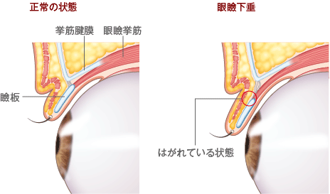 正常の状態と眼瞼下垂