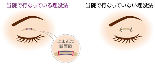 二重整形 2点留め