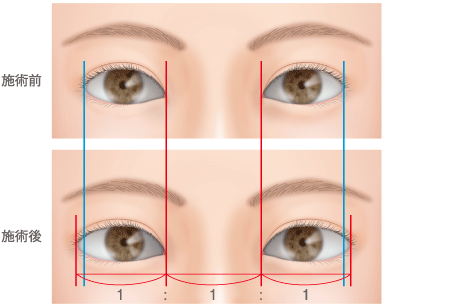 目尻切開の効果と手術内容 美容外科 高須クリニック