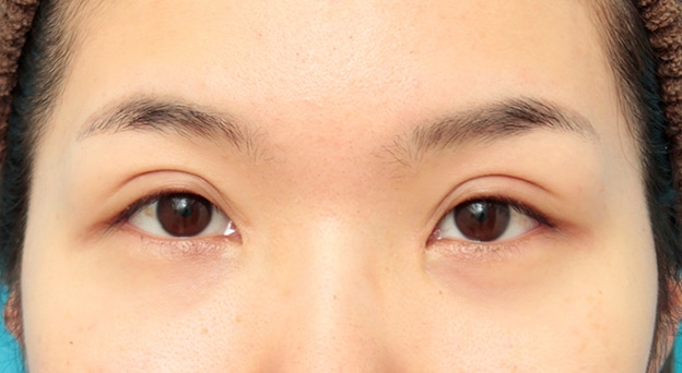 重まぶた部分切開法 ミニ切開法 の特徴と 術内容 高須クリニック