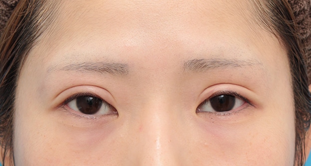 眼瞼下垂 がんけんかすい 二重まぶた 二重瞼 目もと 目元 美容整形の高須クリニック