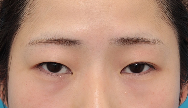 眼瞼下垂 がんけんかすい 二重まぶた 二重瞼 目もと 目元 美容整形の高須クリニック