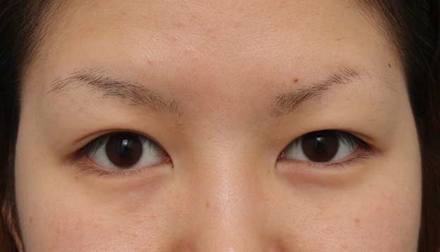 眼瞼下垂 がんけんかすい 二重まぶた 二重瞼 目もと 目元 美容整形の高須クリニック