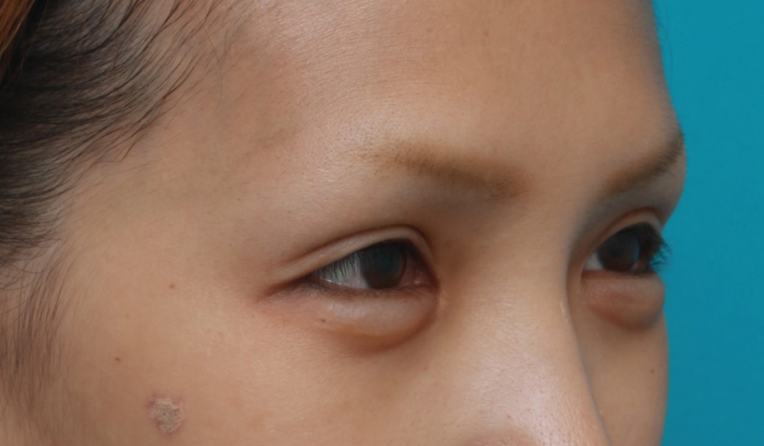 眼瞼下垂の手術で上瞼をひらきぱっちり大きな目に 高須クリニック