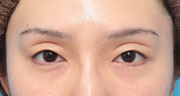 眼瞼下垂 がんけんかすい 二重まぶた 二重瞼 目もと 目元 美容整形の高須クリニック