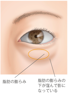 目の下の脂肪取りで切らずに若々しい印象に 高須クリニック