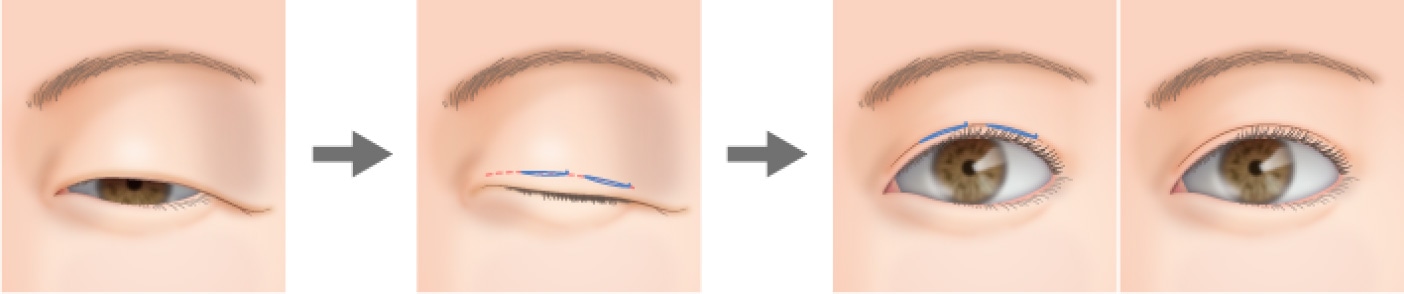 皮膚のたるみが多い場合