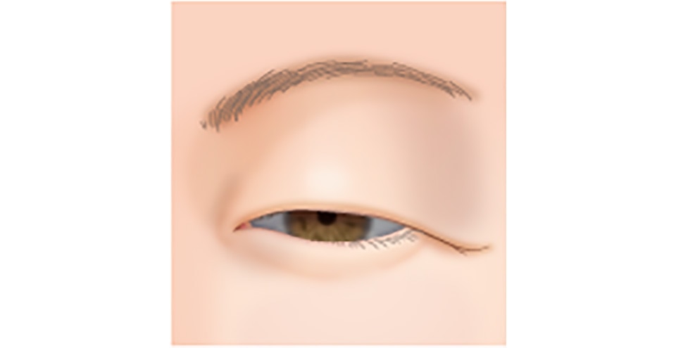 皮膚のたるみが多い場合