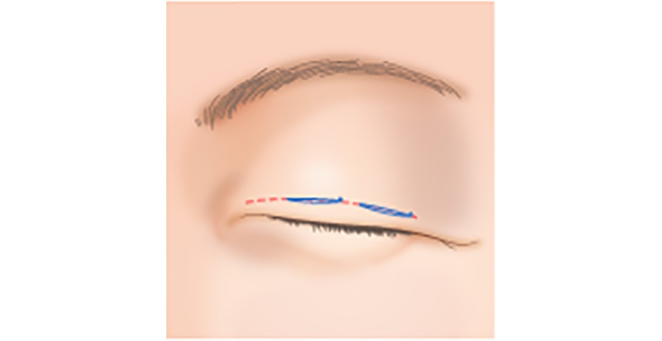 皮膚のたるみが多い場合