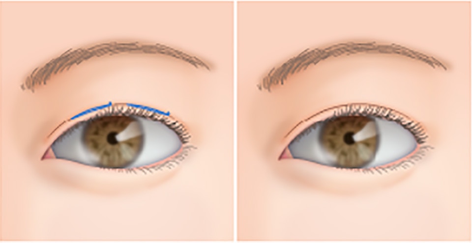 皮膚のたるみが多い場合