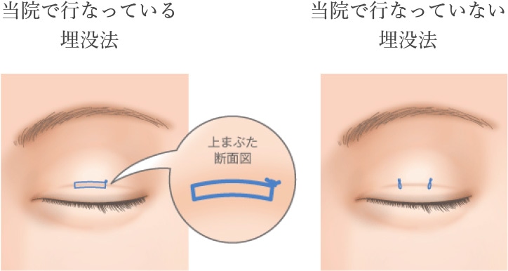 当院で行なっている埋没法 当院で行なっていない埋没法