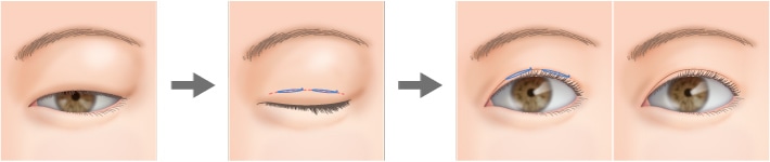 皮膚や脂肪が分厚い場合