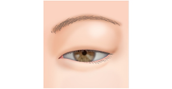 皮膚や脂肪が分厚い場合